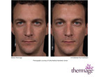 Results using the new Total Tip from Thermage﻿!
